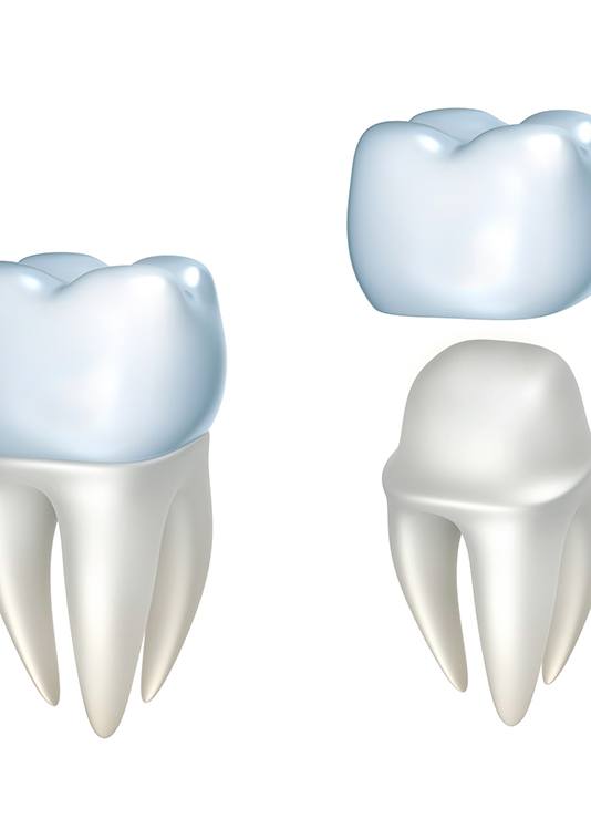 Digital model of dental crown being placed over a tooth