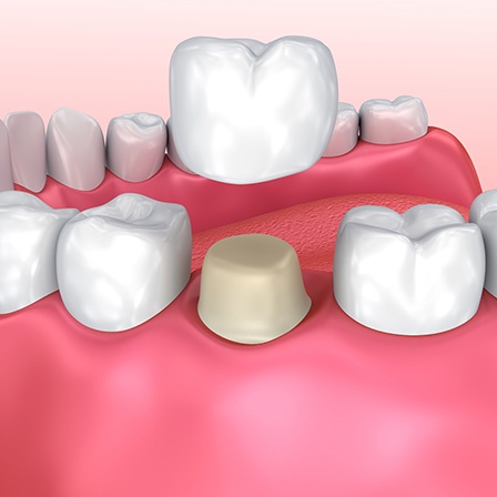 Tooth prepped for a dental crown