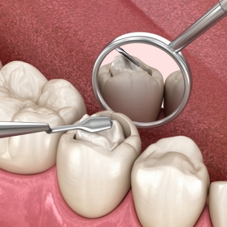 Illustrated filling being placed inside of a tooth