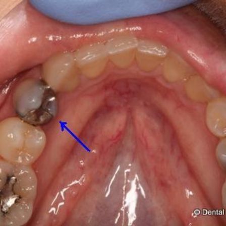 Close up of mouth with arrow pointing to metal dental crown